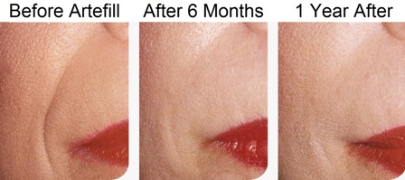 ArteFill Smile Correction ArteFill Smile Correction
