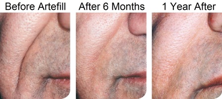 ArtefillBeforeAfter_Male_Web ArteFill Smile Correction