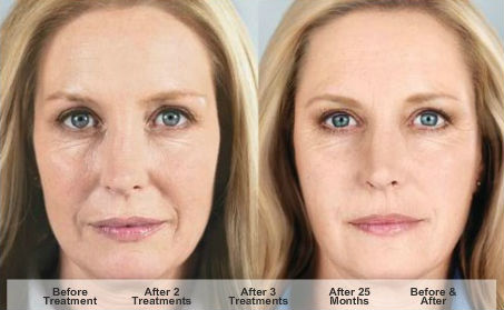 Sculptra Before After