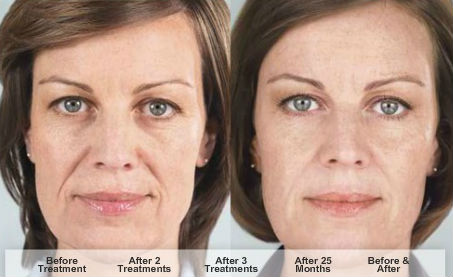 Sculptra Before After