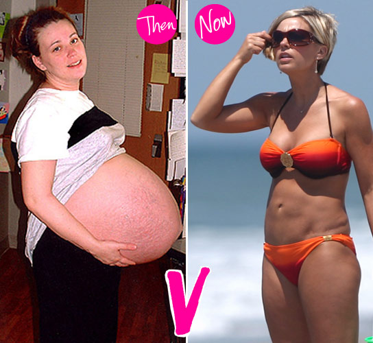 Kate Before And After Tummy Tuck. Kate Gosselin: My Tummy Tuck