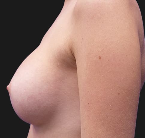 Case 32211 , Performed By Dr. Tehrani – angle 3 After