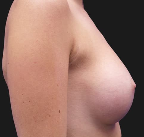 Case 32211 , Performed By Dr. Tehrani – angle 4 After