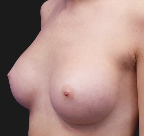 Case 32211 , Performed By Dr. Tehrani – angle 5 After
