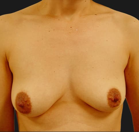 Case 6268, Performed By Dr. Tehrani – Before