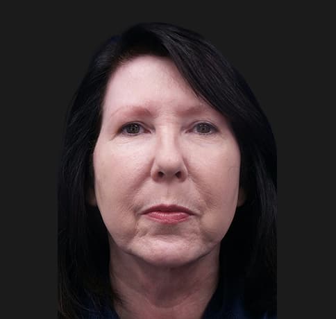 Case 33266 , Performed By Dr. Tehrani – angle 3 After