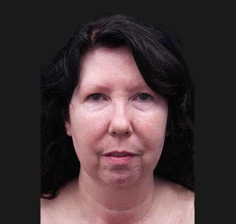 Case 33266 , Performed By Dr. Tehrani – angle 3 Before
