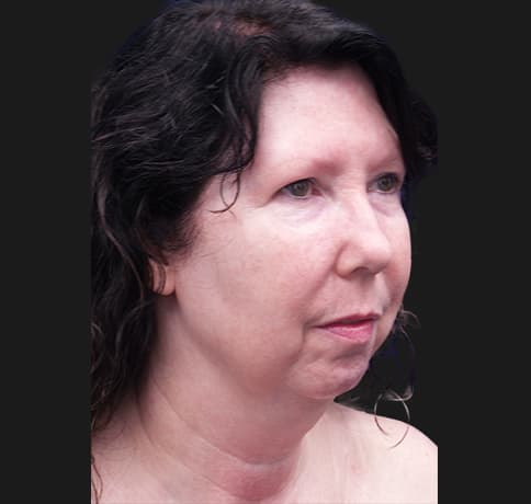 Case 33266 , Performed By Dr. Tehrani – angle 4 Before