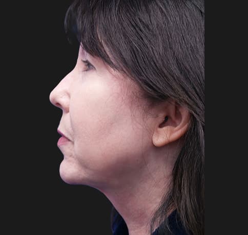 Case 33266 , Performed By Dr. Tehrani – angle 2 After