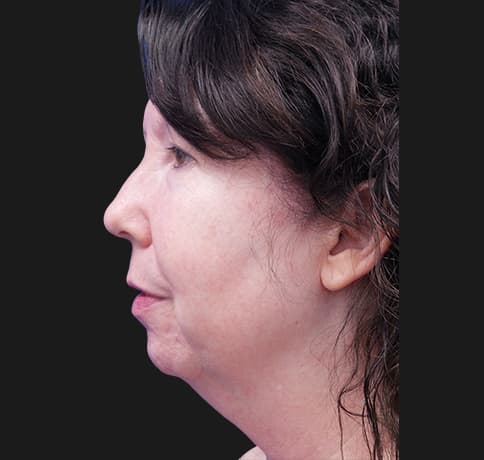 Case 33266 , Performed By Dr. Tehrani – angle 2 Before