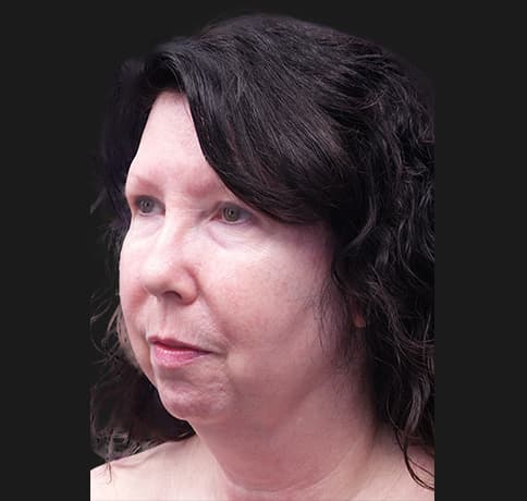 Case 33266 , Performed By Dr. Tehrani – angle 5 Before
