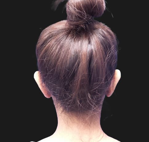 Case 32473, Performed By Dr. Tehrani – angle 2 After