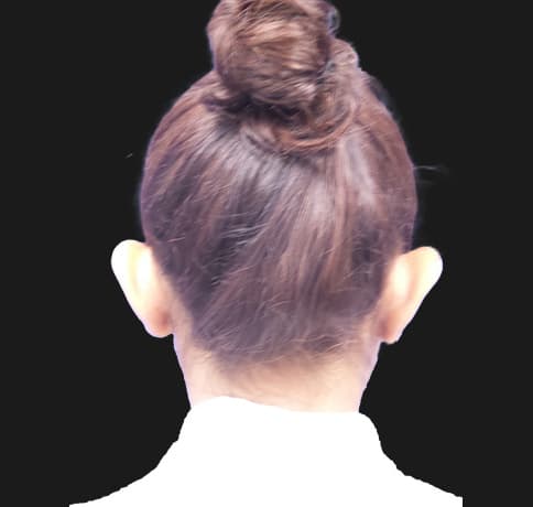 Case 32473, Performed By Dr. Tehrani – angle 2 Before