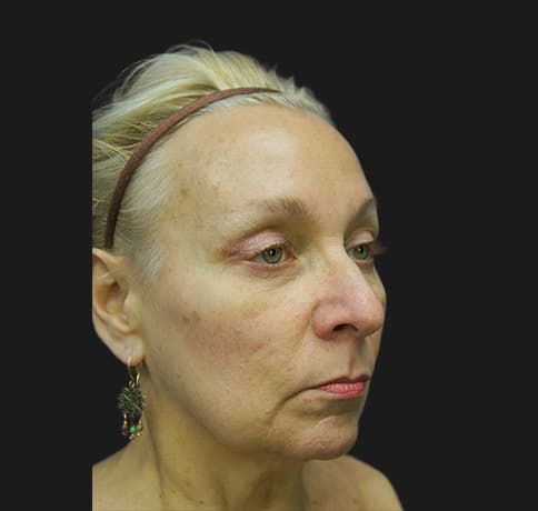 Case 28242 , Performed By Dr. Tehrani – angle 2 After