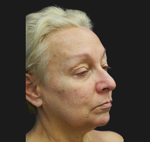 Case 28242 , Performed By Dr. Tehrani – angle 2 Before