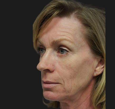 Case 22472 , Performed By Dr. Tehrani – After