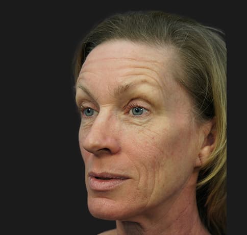 Case 22472 , Performed By Dr. Tehrani – Before