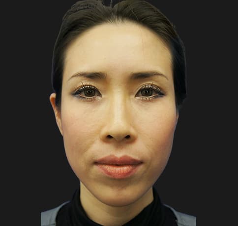 Case 21630 , Performed By Dr. Tehrani – After