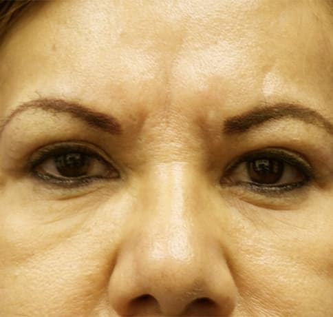 Case 12700, Performed By Dr. Tehrani – After