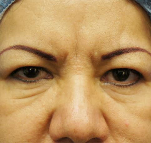 Case 12700, Performed By Dr. Tehrani – Before