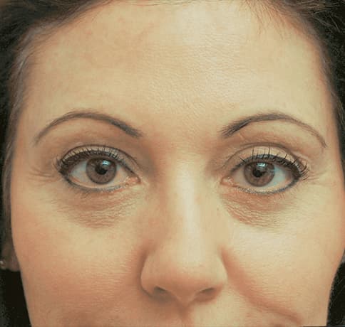 Case 3918, Performed By Dr. Tehrani – After