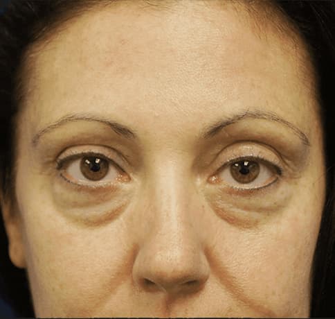 Case 3918, Performed By Dr. Tehrani – Before