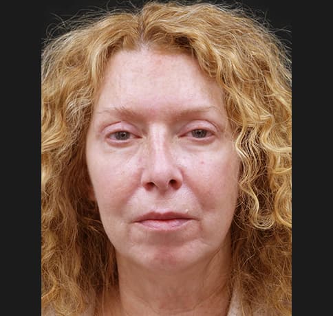 Case 47395, Performed By Dr. Tehrani – After