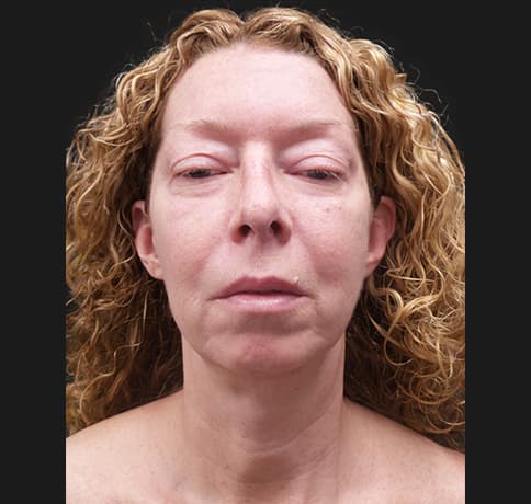 Case 47395, Performed By Dr. Tehrani – Before