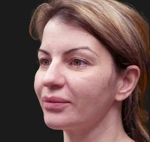 Case 47824, Performed By Dr. Tehrani – angle 2 Before