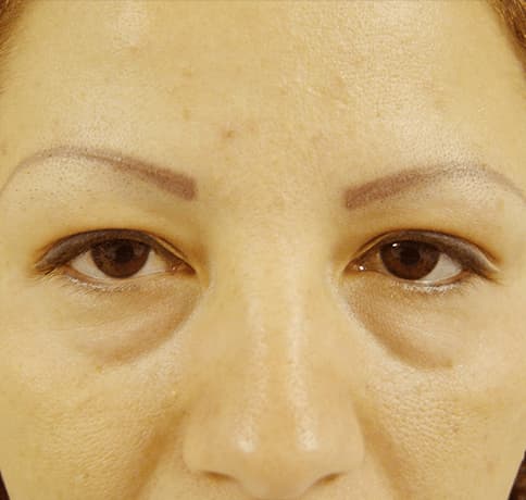Case 6667 , Performed By Dr. Tehrani – Before
