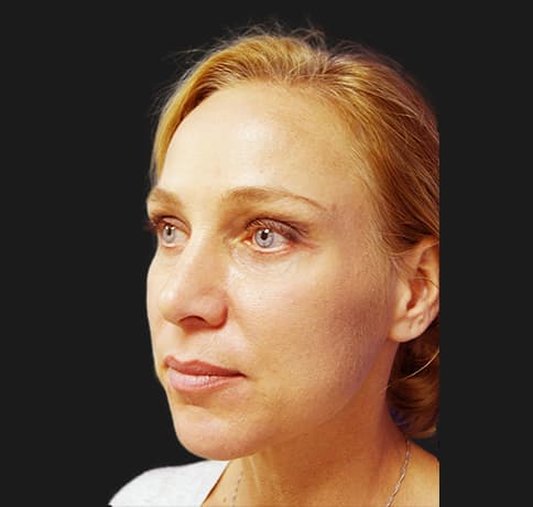 Case 9982 , Performed By Dr. Tehrani – angle 2 After