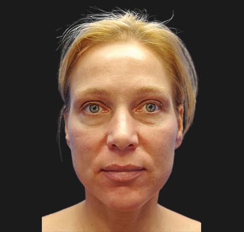 Case 9982 , Performed By Dr. Tehrani – angle 2 Before