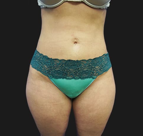 Case 22598, Performed By Dr. Tehrani – After