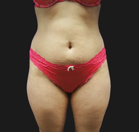 Case 22598, Performed By Dr. Tehrani – Before