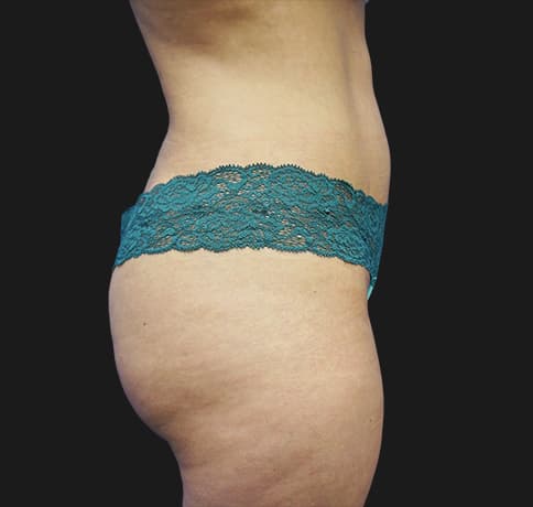 Case 22598, Performed By Dr. Tehrani – After