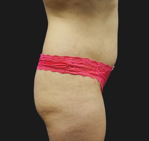 Case 22598, Performed By Dr. Tehrani – Before
