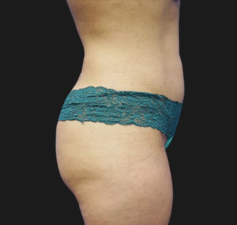 Case 22598, Performed By Dr. Tehrani – angle 3 After