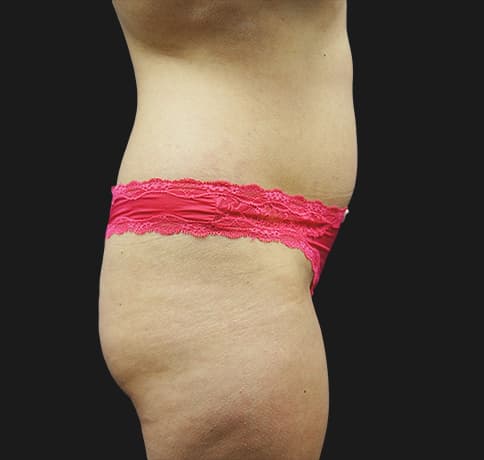 Case 22598, Performed By Dr. Tehrani – angle 3 Before