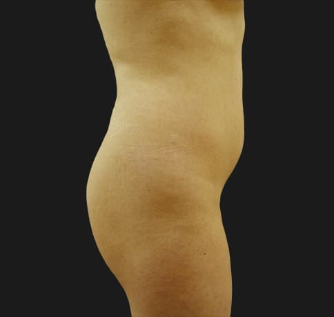Case 10288, Performed By Dr. Tehrani – angle 2 Before