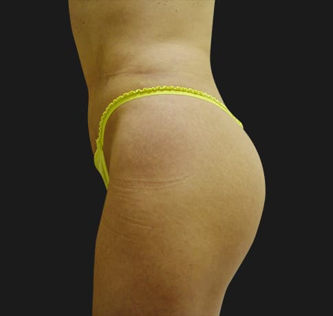 Case 10288, Performed By Dr. Tehrani – angle 3 After