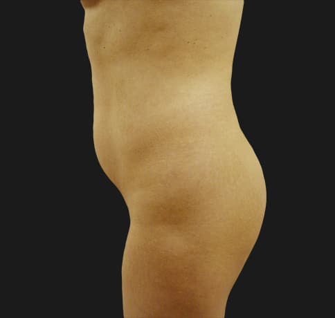 Case 10288, Performed By Dr. Tehrani – angle 3 Before