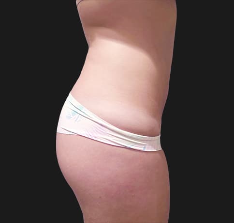 Case 37388, Performed By Dr. Tehrani – angle 2 After
