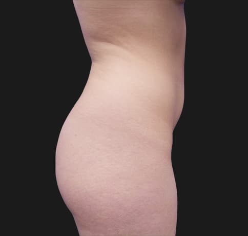 Case 37388, Performed By Dr. Tehrani – angle 2 Before