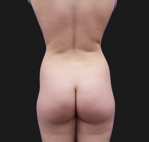 Case 37388, Performed By Dr. Tehrani – angle 3 Before
