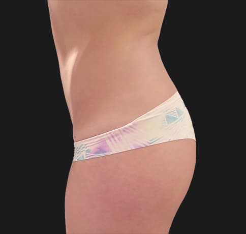 Case 37388, Performed By Dr. Tehrani – angle 4 After