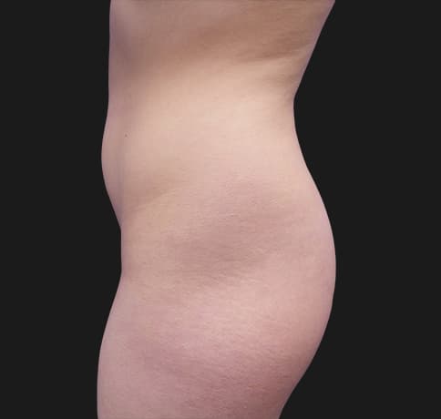 Case 37388, Performed By Dr. Tehrani – angle 4 Before