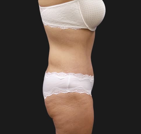 Case 41835, Performed By Dr. Tehrani – After