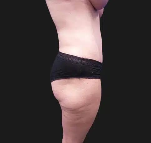 Case 39896, Performed By Dr. Tehrani – After