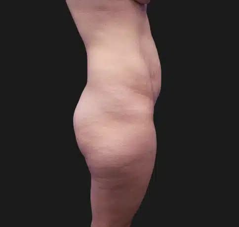 Case 39896, Performed By Dr. Tehrani – Before