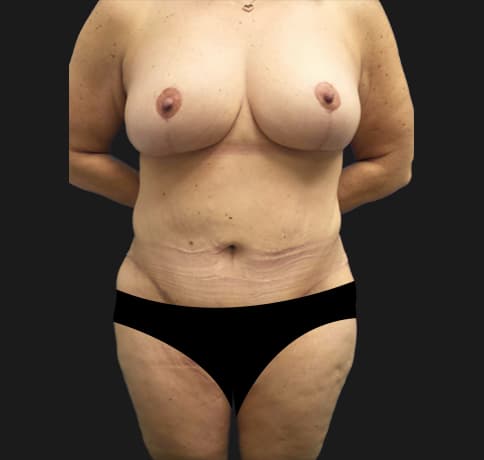 Case 4, Performed By Dr. Tehrani – After